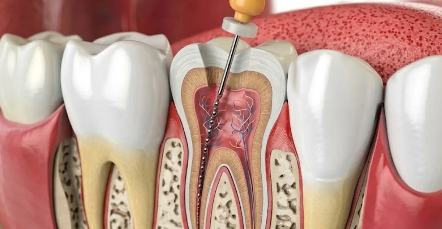 RCT Molar Teeth 2